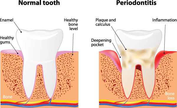 The image is a medical illustration showing four stages of tooth decay progression from normal to periodontitis, with accompanying text labels for each stage.