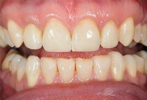 The image displays a close-up view of a person s teeth with visible staining, particularly on the front teeth, set against a neutral background.