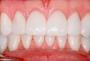 The image displays a close-up view of a person s teeth, showcasing a bright smile with a clean and healthy appearance.