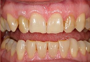 The image shows a close-up view of a person s teeth with severe discoloration and staining, possibly due to neglect or health issues.