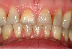 The image shows a close-up view of a person s teeth with some discoloration and staining, particularly noticeable on the lower front teeth.