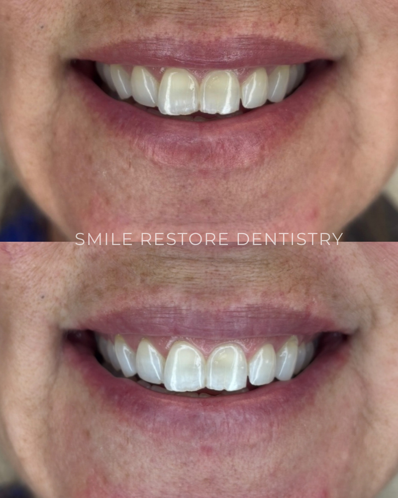 teeth whitening near me